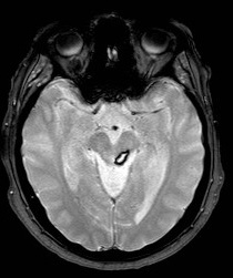 Midbrain Cavernoma Image 1