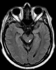 Midbrain Cavernoma Image 2