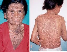 Image showing Neurofibromatosis Type 1 features