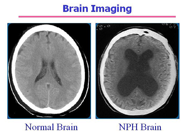 CT scan of NPH