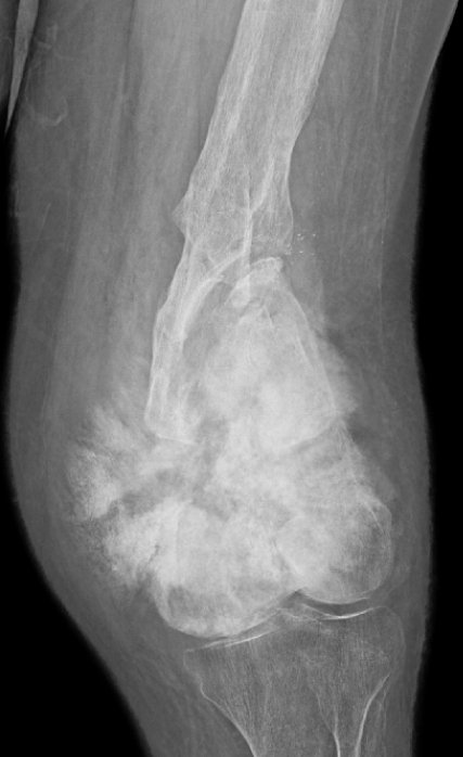 Osteosarcoma X-ray