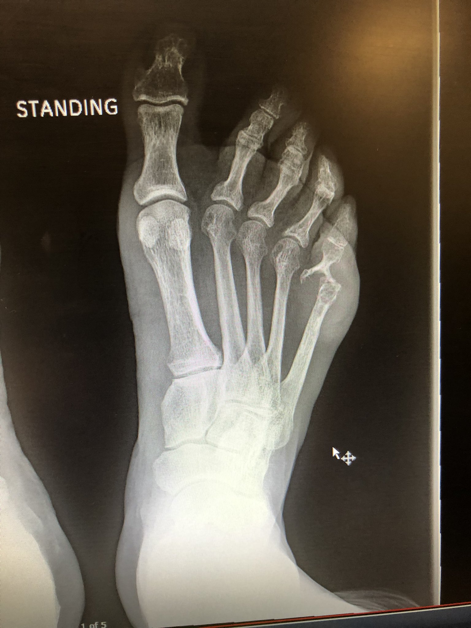 Pencil-in-Cup Deformity in Psoriatic Arthritis