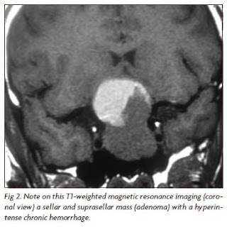 MRI of Pituitary Apoplexy