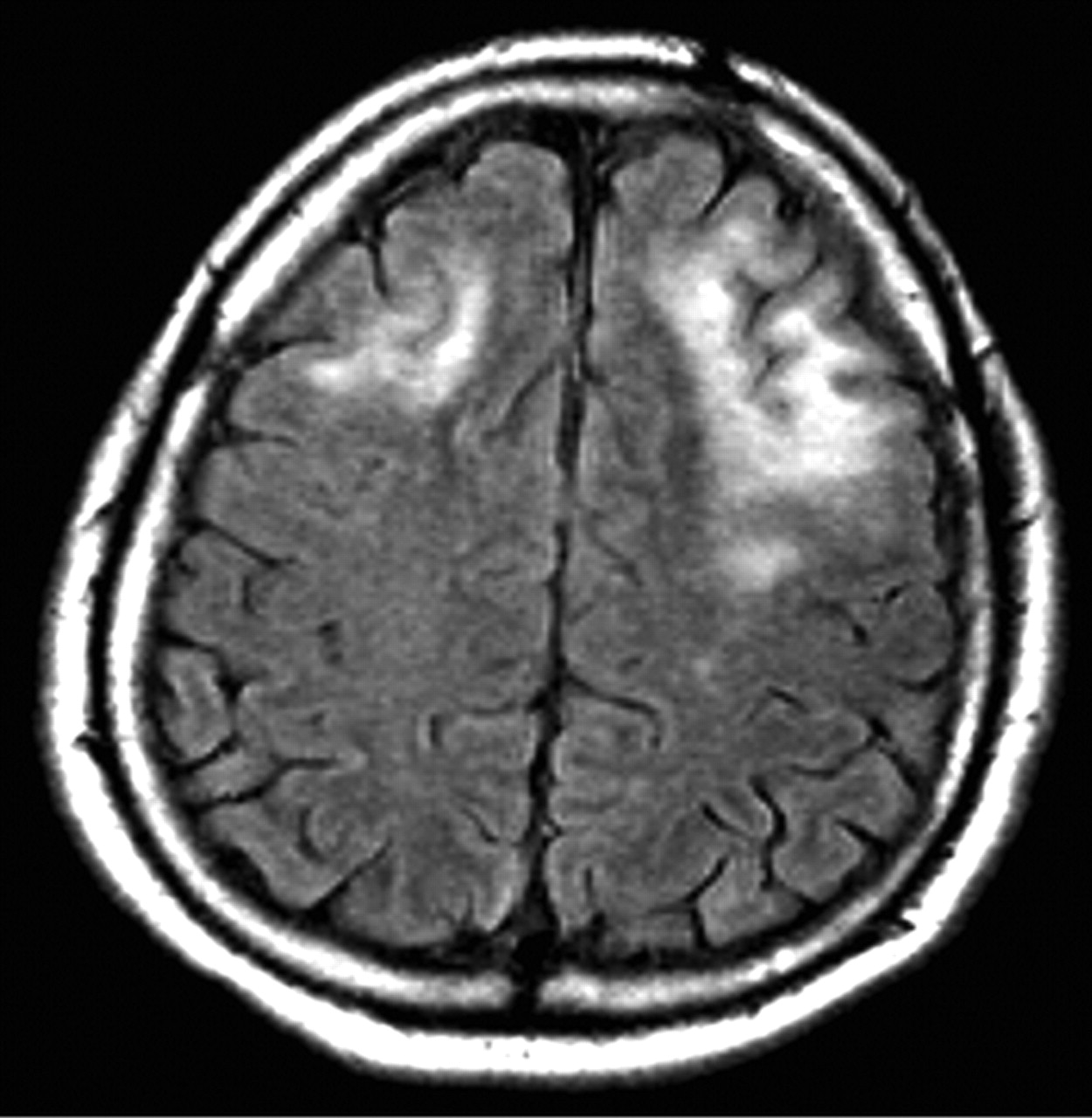 PML MRI Image 1