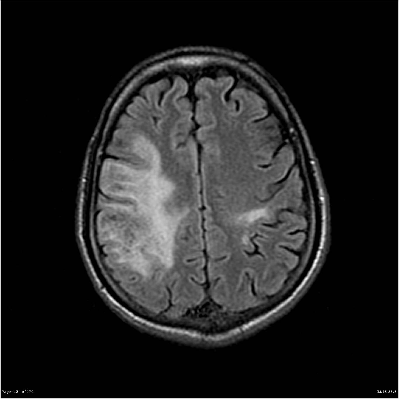 PML MRI Image 2