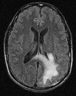 PML MRI Image 3