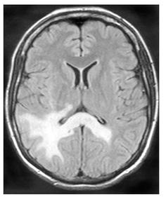 PML MRI Image 4