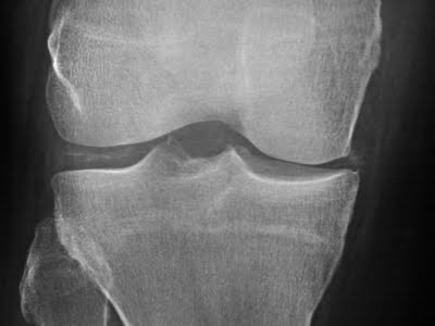 Chondrocalcinosis X-ray Image