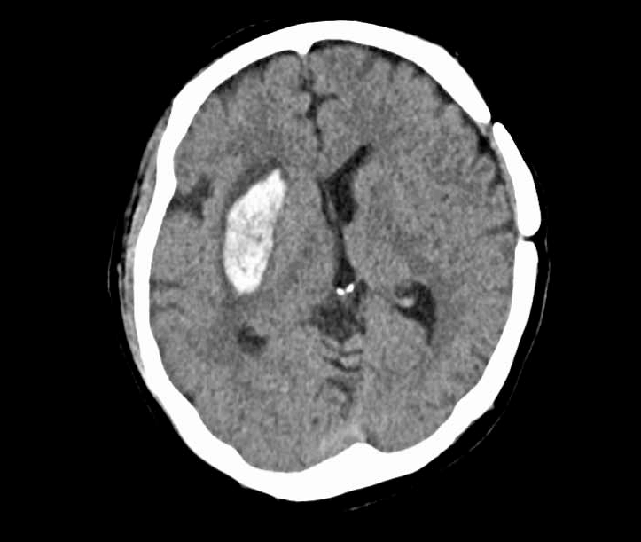 Hemorrhage Location in Putamen