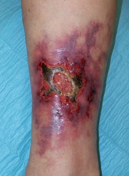 Pyoderma Gangrenosum Ulcer