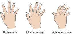 Rheumatoid nodule histology