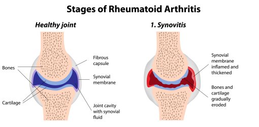 RA affected joints