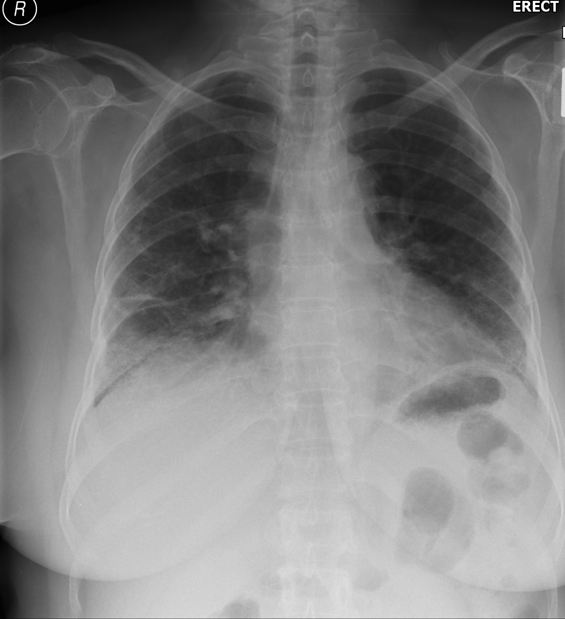 Rheumatoid Lung