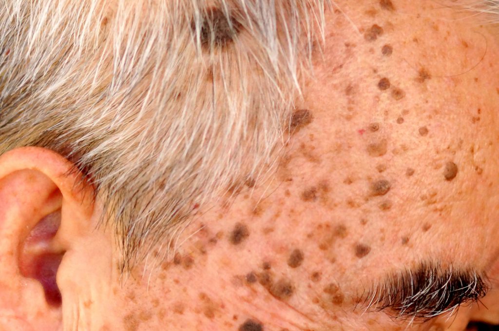 Example of Seborrheic Keratosis lesions