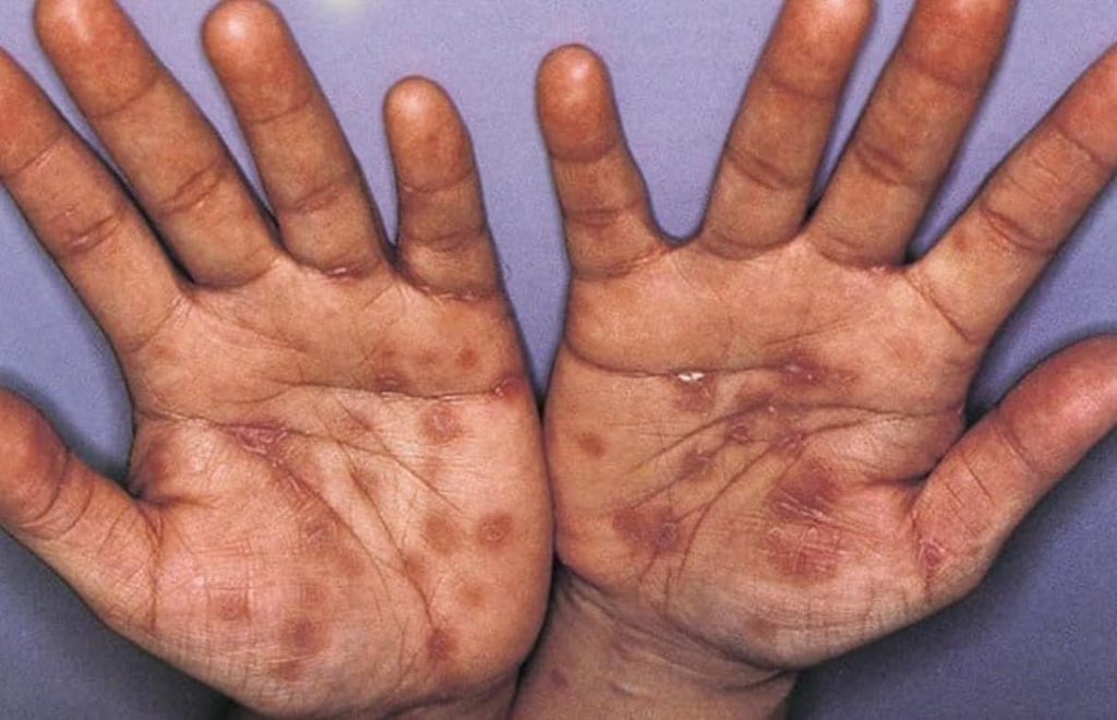 Secondary Syphilis Lesions on Hands