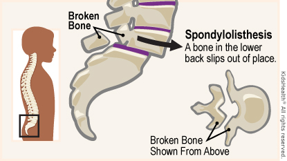 Spondylolisthesis