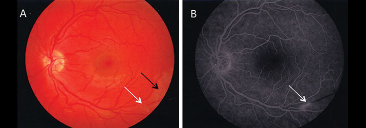 Susac syndrome MRI image