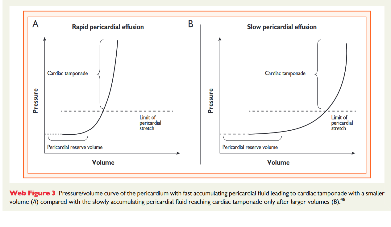 Illustration of Tamponade