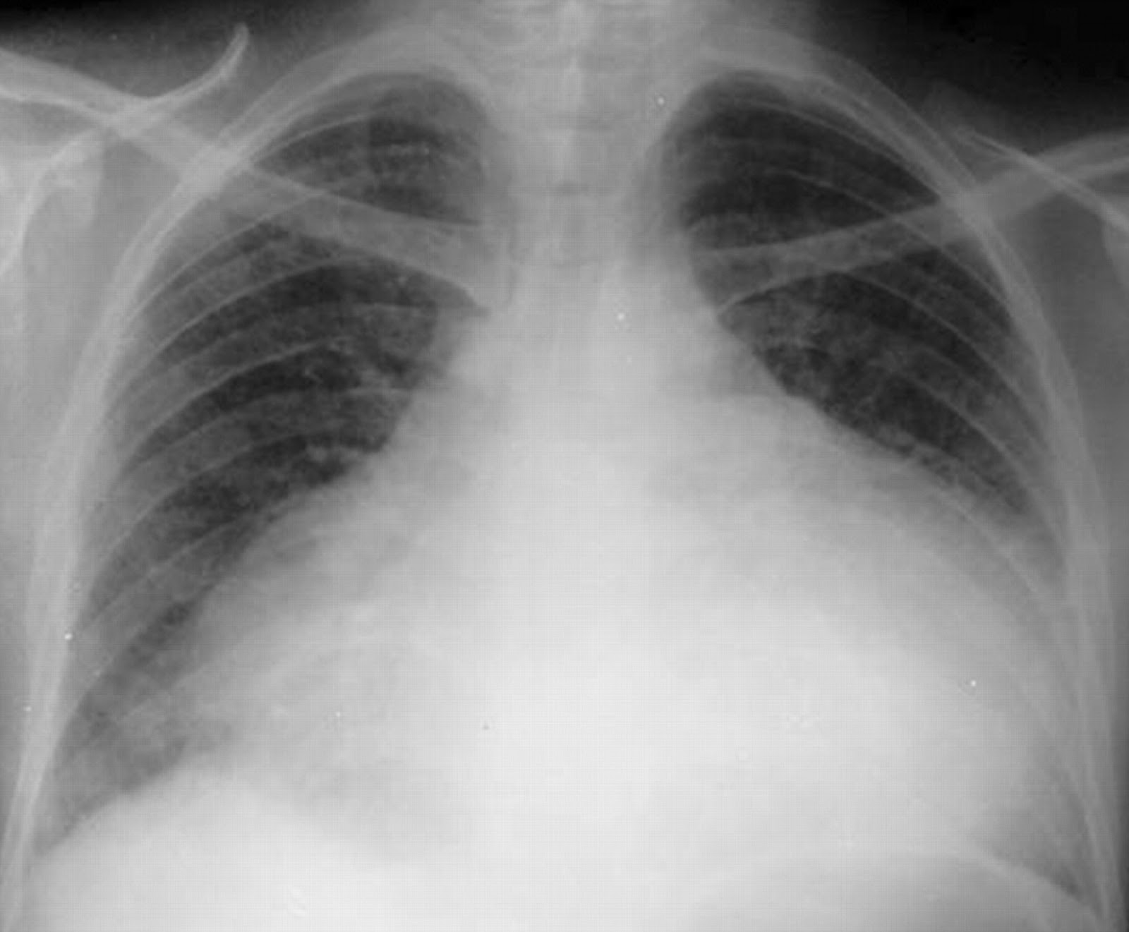 Large globular heart in Pericardial Effusion