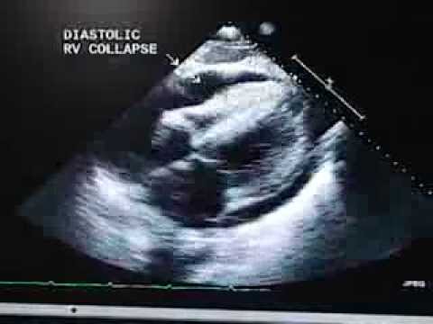 Echocardiogram showing diastolic collapse of RV