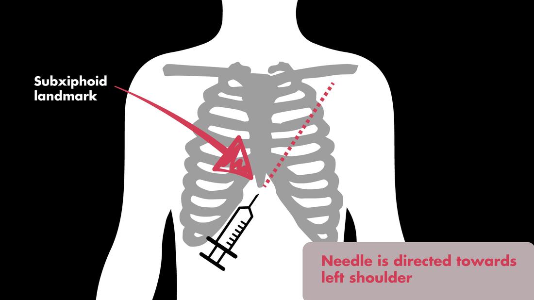 Emergency pericardiocentesis guide