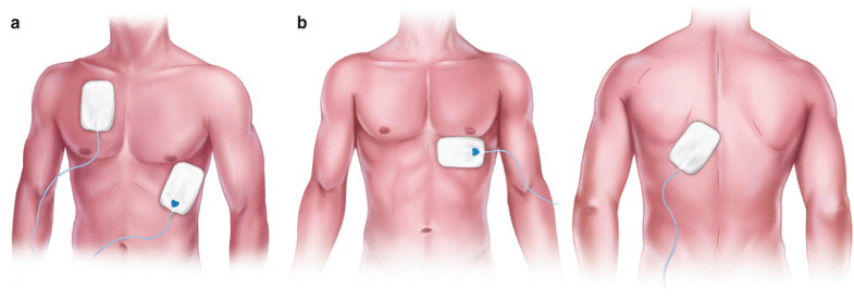 Transcutaneous Pacing illustration