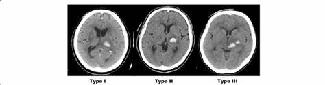 Thalamic Stroke Image