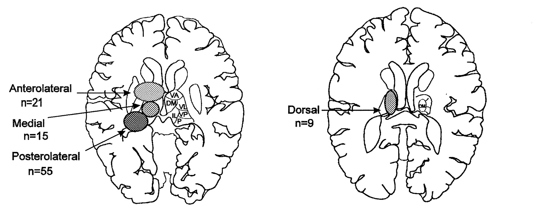 Thalamic Stroke Image