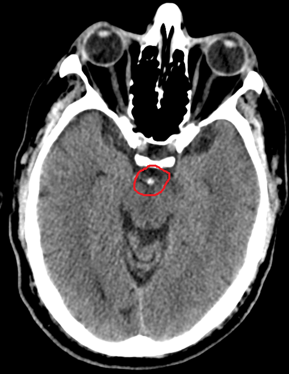 Hyperdense Basilar Artery