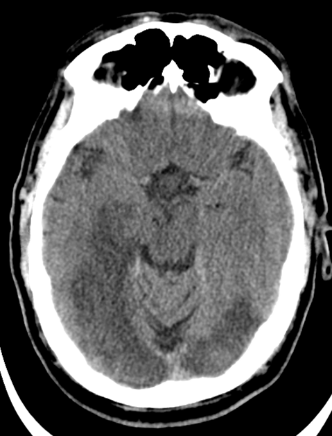 Posterior Circulation Infarct