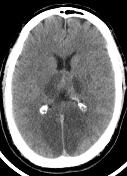 MRI of Posterior Circulation Infarct