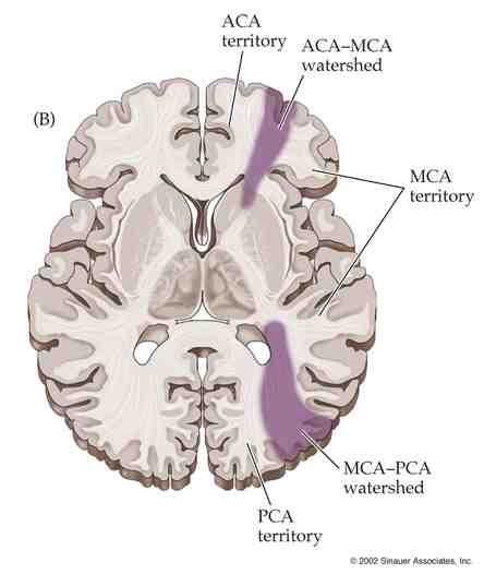 Diagram of Watershed Infarcts